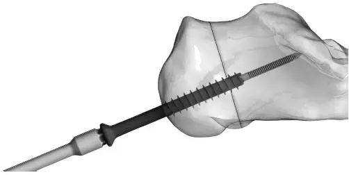 Large Cannulated Screws without Sleeve Assembly 5