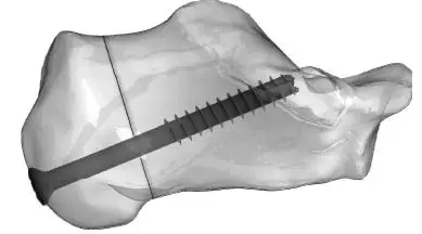 Large Cannulated Screws without Sleeve Assembly 6