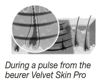 beurer IPL 8500 Velvet Skin Pro Long Lasting Hair Removal -fig 1