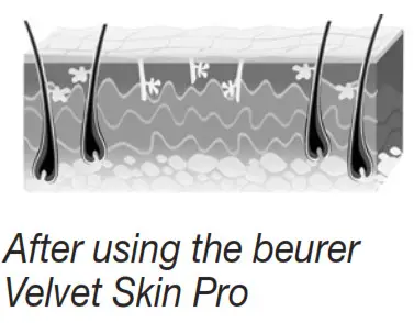 beurer IPL 8500 Velvet Skin Pro Long Lasting Hair Removal -fig 3