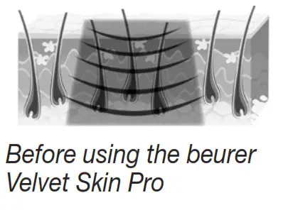 beurer IPL 8500 Velvet Skin Pro Long Lasting Hair Removal -fig