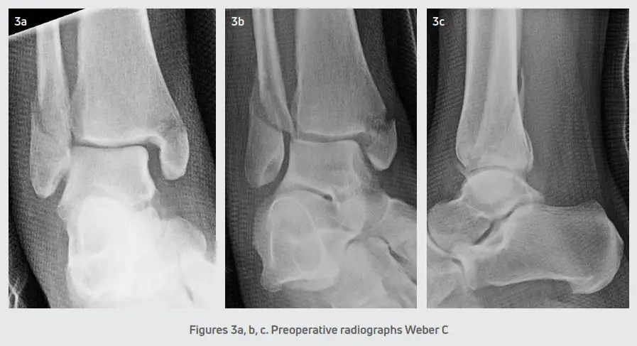 DJO Gridlock Ankle Plating System - Patients and Methods