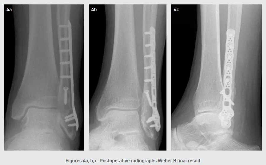 DJO Gridlock Ankle Plating System - Procedure 2
