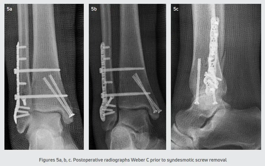 DJO Gridlock Ankle Plating System - Procedure 3
