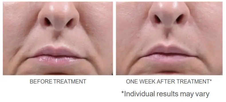 RADIESSE-Lidocaine-Injectable-Implant-fig-1