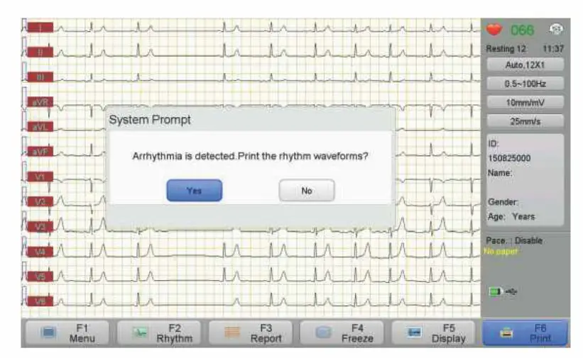Arrhythmia detection