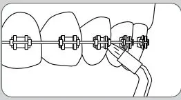 Waterpik Water Flosser WF-07 User Guide - Orthodontic Tip