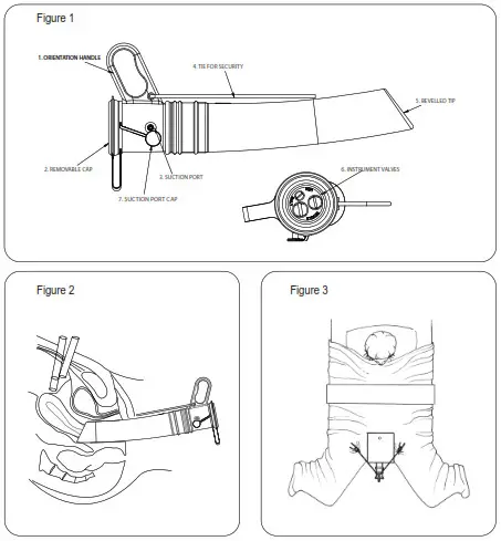 symmetry surgical McCartney Trans Vaginal Tube with 3 Way valve and Silicone Tie - figure