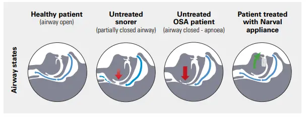 ResMed Mandibular Repositioning Device-1