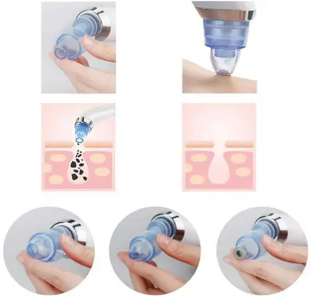 Olrom-BR002-Electric-Vacuum-Suction-Blackhead-Remover-fig-1