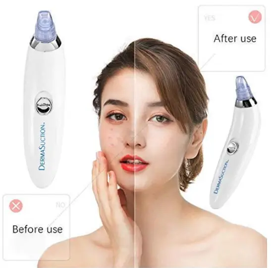 Olrom-BR002-Electric-Vacuum-Suction-Blackhead-Remover-fig-2