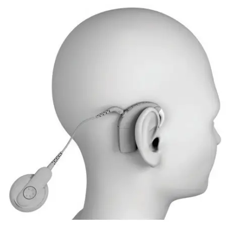Cochlear Nucleus 8 Sound Processor - fig 5