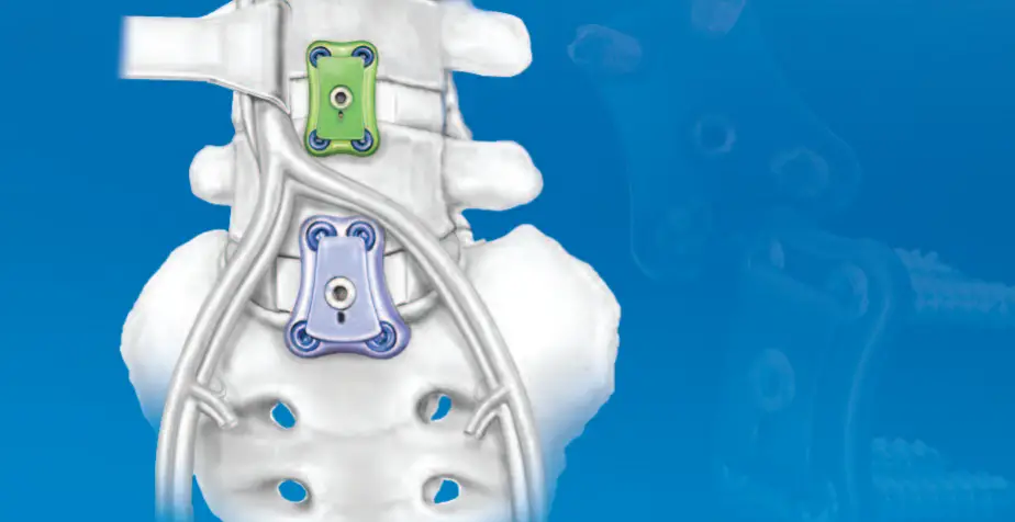 Orthofix Aw-43-9902 Unity Lumbosacral Fixation System Instruction Manual Orthofix Aw-43-9902 Unity Lumbosacral Fixation System Instruction Manual