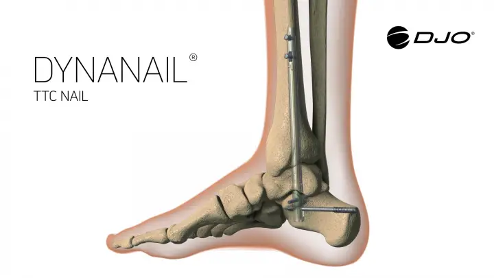 Djo Dynanail Helix Fixation System Instruction Manual