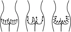 Cellulite and accumulation of fat