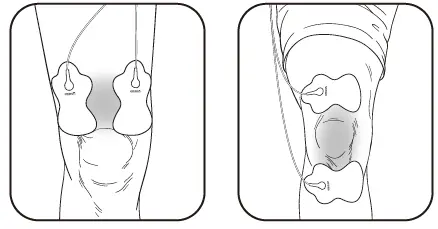 OMRON-HV-F021-Electronic-Nerve-Stimulator-FIG-14