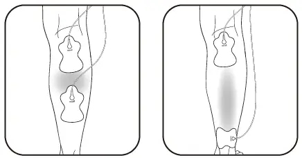 OMRON-HV-F021-Electronic-Nerve-Stimulator-FIG-16