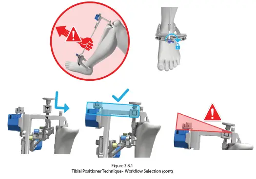 orthosoft-50001-Computer-Assisted-Stereotaxic-Surgical-Instrument-System-FIG-1
