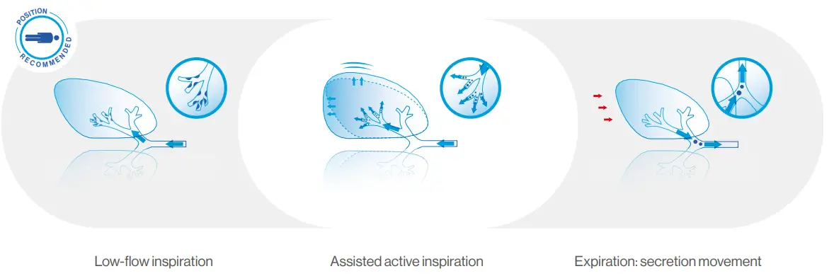 Air-Liquide-EOVETM-70-Electric-Mucus-Suction-Pump-FIG-7