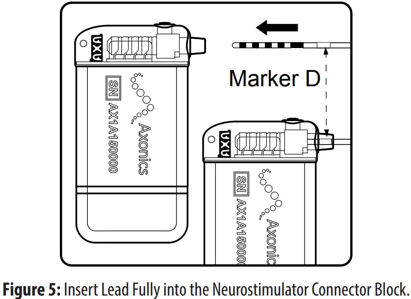 Axonics 1101 Sacral Neuromodulation System - Connector Block