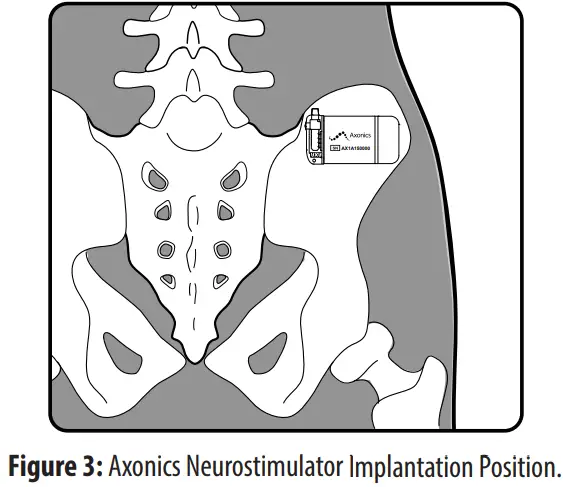 Axonics 1101 Sacral Neuromodulation System - Implantation Position