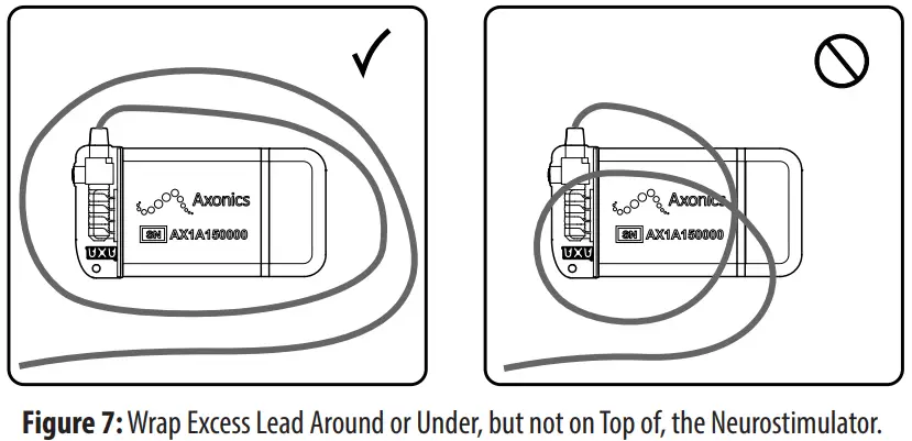 Axonics 1101 Sacral Neuromodulation System - Wrap Excess Lead