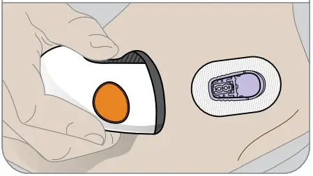 Dexcom G6 Continuous Glucose Monitoring System - Remove applicator