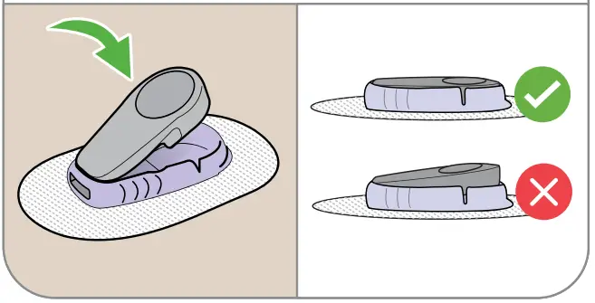 Dexcom G6 Continuous Glucose Monitoring System - Snap in transmitter