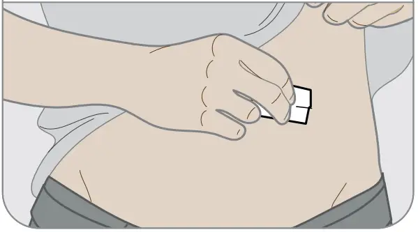Dexcom G6 Continuous Glucose Monitoring System - sensor site 1