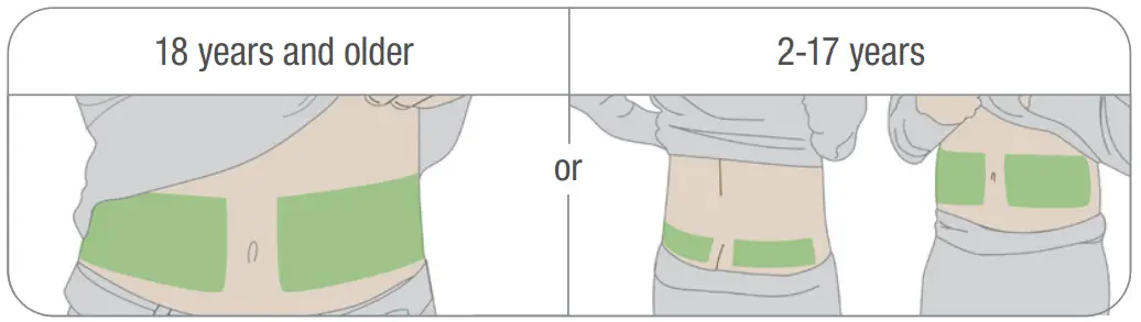 Dexcom G6 Continuous Glucose Monitoring System - sensor site
