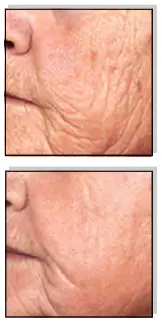 Avance Beauty IPL 350 LS Ultra and Driver - Rejuvenation