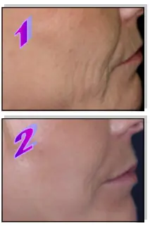 Avance Beauty IPL 350 LS Ultra and Driver - Resurfacing