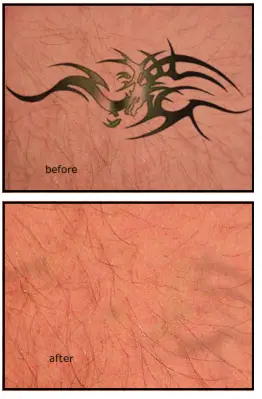 Avance Beauty IPL 350 LS Ultra and Driver - Resurfacingdd