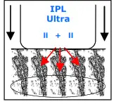 Avance Beauty IPL 350 LS Ultra and Driver - Resurfacinsg