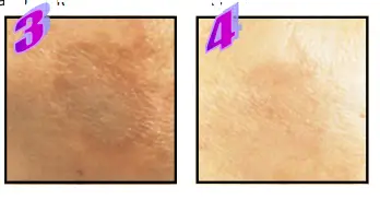 Avance Beauty IPL 350 LS Ultra and Driver - Spots