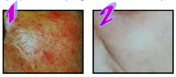 Avance Beauty IPL 350 LS Ultra and Driver - Treatment