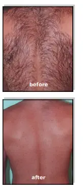 Avance Beauty IPL 350 LS Ultra and Driver - exercised d