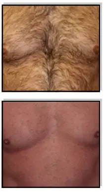 Avance Beauty IPL 350 LS Ultra and Driver - skin