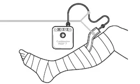 Smith Nephew PICO 7 PICO Single Use Negative Pressure Wound Therapy Systems fig-7