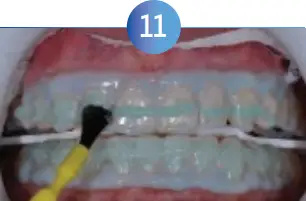 GLO Science PRO POWER+ - Indicates Technique Sensitive Step 11