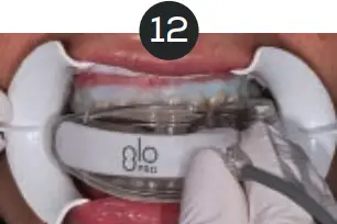 GLO Science PRO POWER+ - Indicates Technique Sensitive Step 12