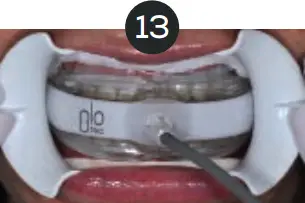 GLO Science PRO POWER+ - Indicates Technique Sensitive Step 13