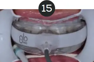 GLO Science PRO POWER+ - Indicates Technique Sensitive Step 15