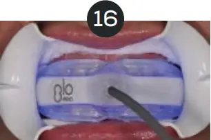 GLO Science PRO POWER+ - Indicates Technique Sensitive Step 16