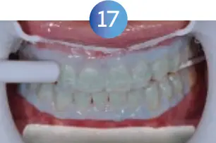 GLO Science PRO POWER+ - Indicates Technique Sensitive Step 17