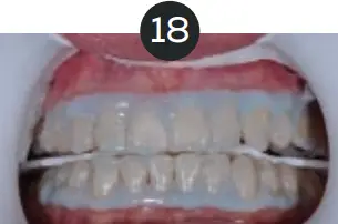 GLO Science PRO POWER+ - Indicates Technique Sensitive Step 18