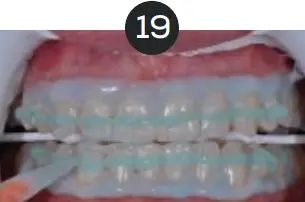 GLO Science PRO POWER+ - Indicates Technique Sensitive Step 19