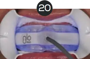 GLO Science PRO POWER+ - Indicates Technique Sensitive Step 20