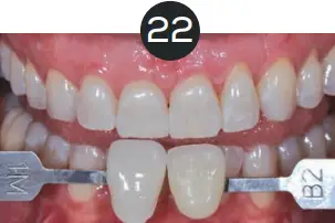 GLO Science PRO POWER+ - Indicates Technique Sensitive Step 22