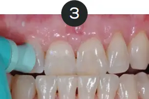 GLO Science PRO POWER+ - Indicates Technique Sensitive Step 3